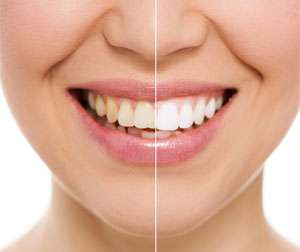 Teeth before and after - Dentistry in Philadelphia, PA Teeth before and after - Dentistry in Philadelphia, PA