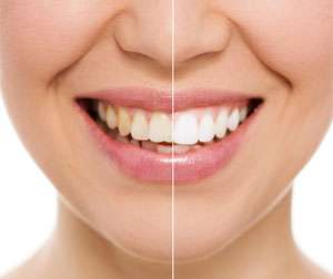 Teeth before and after - Dentistry in Philadelphia, PA