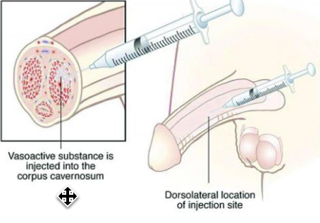 A diagram of prostate cancer treatment