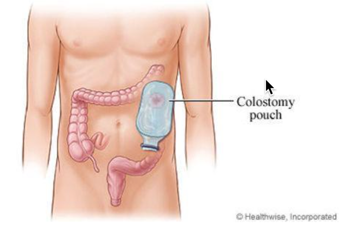 A drawing of a person 's stomach with a colostomy pouch attached to it.