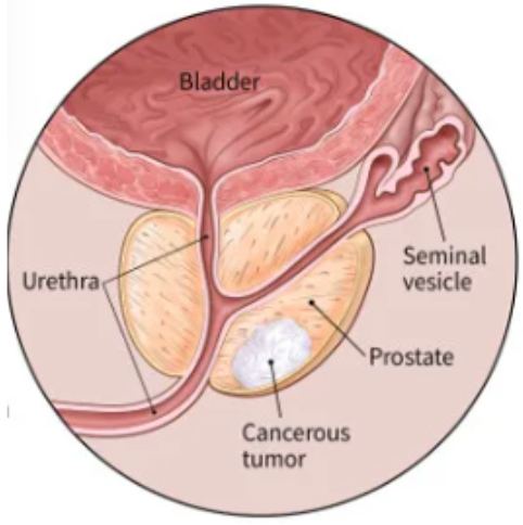 A diagram of a bladder with a cancerous tumor