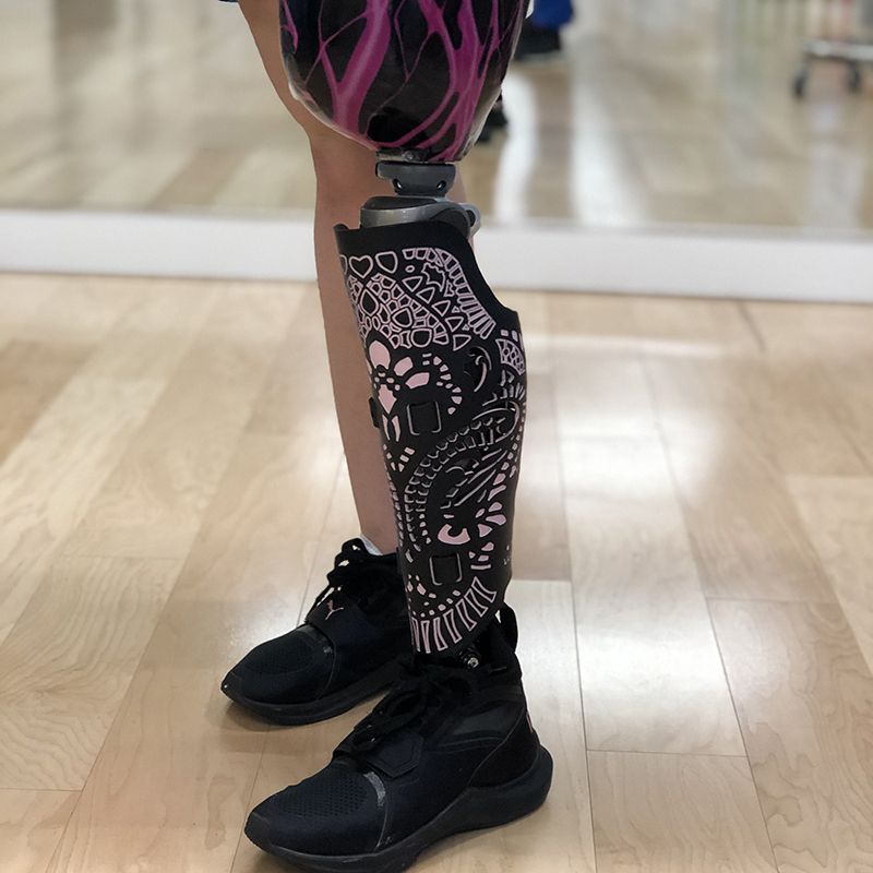 A person with a prosthetic leg is wearing black shoes