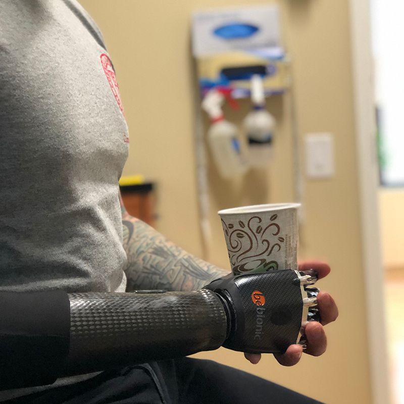 A person with a prosthetic arm is holding a cup of coffee