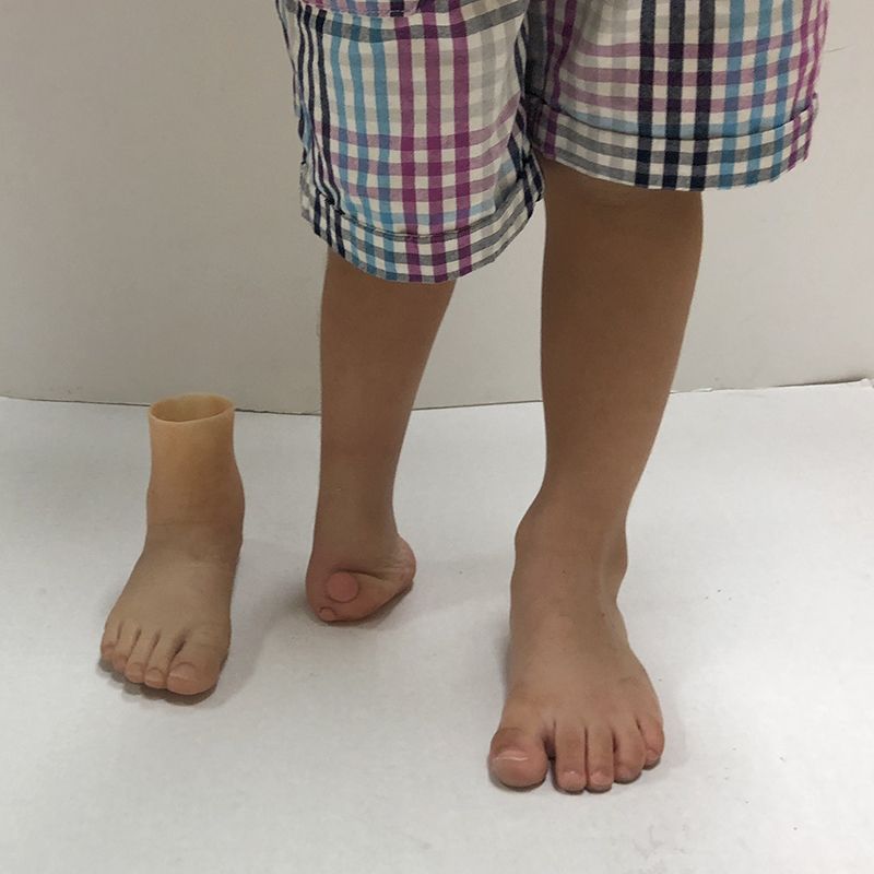 A person with a prosthetic foot and bare feet