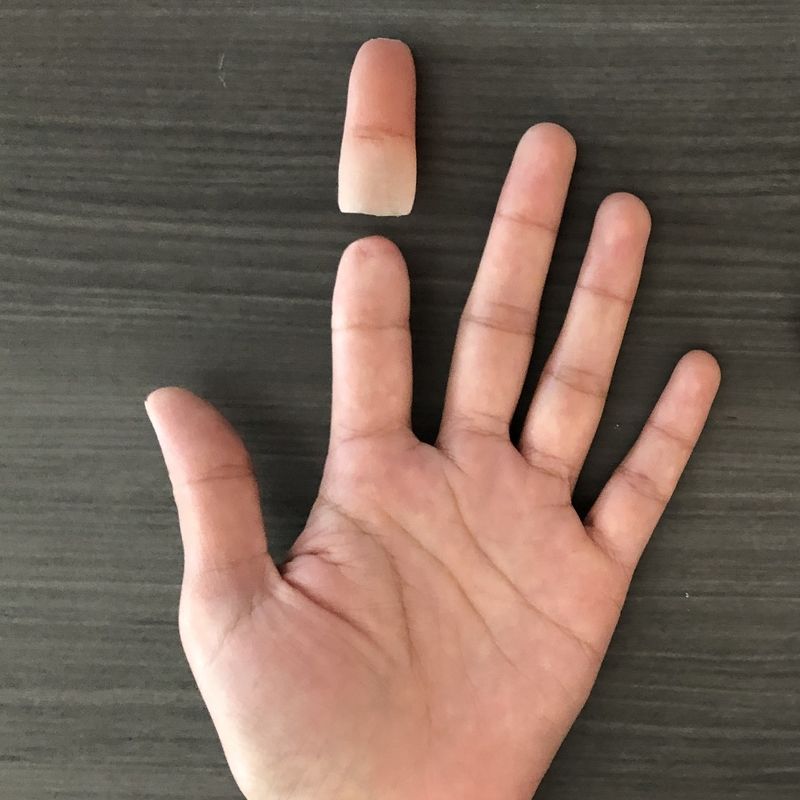 A person 's hand with a broken thumb