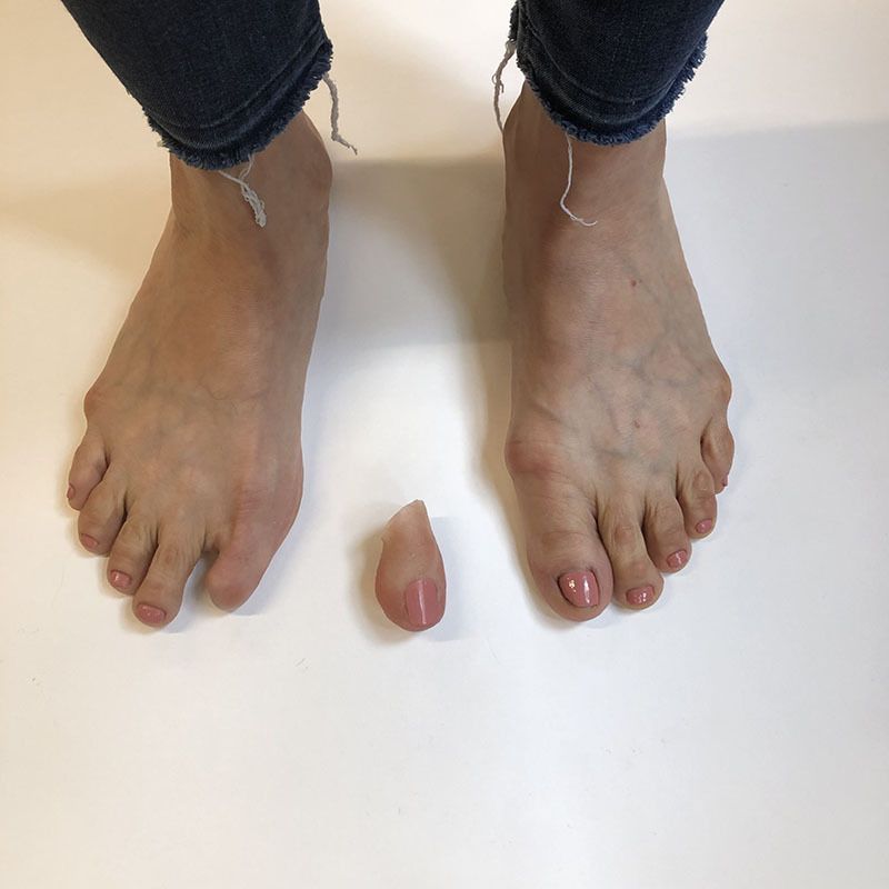 A person 's feet with one toe missing