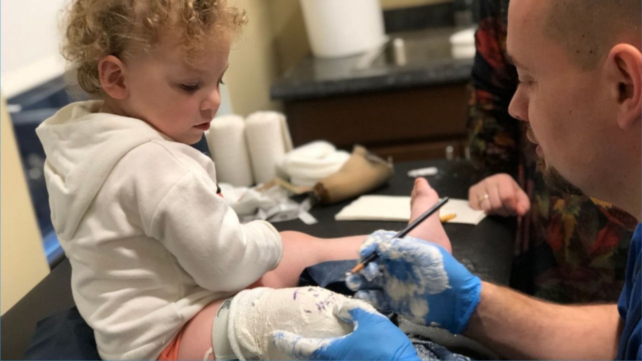 A man is casting a little boy for a prosthetic leg.
