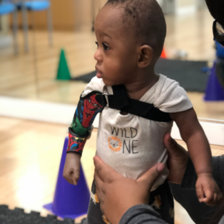A baby with a custom transhumeral prosthesis with a pediatric TRS device