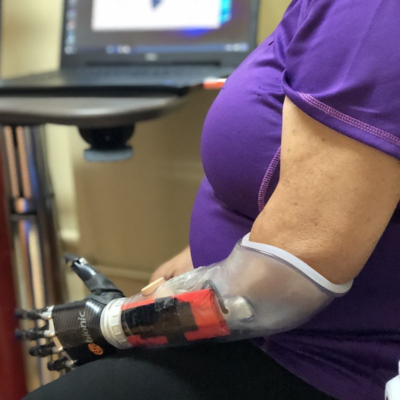 A woman with a prosthetic arm is sitting in front of a laptop