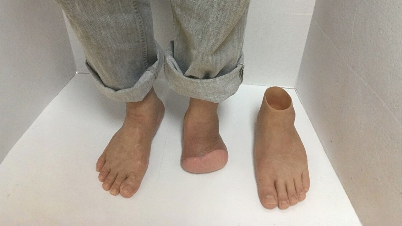 A person with a partial foot silicone prosthesis.