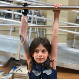 A young girl with a prosthetic arm hangs from a bar