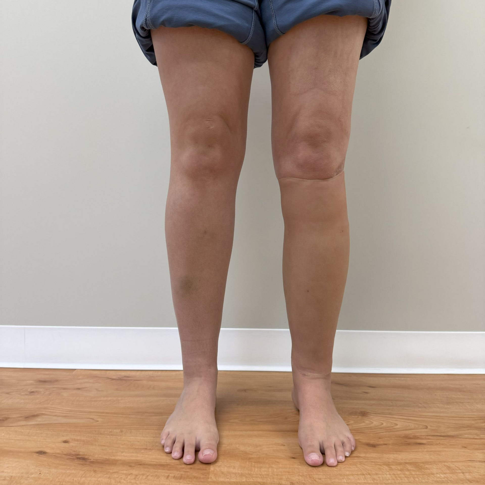 silicone skin cover after image