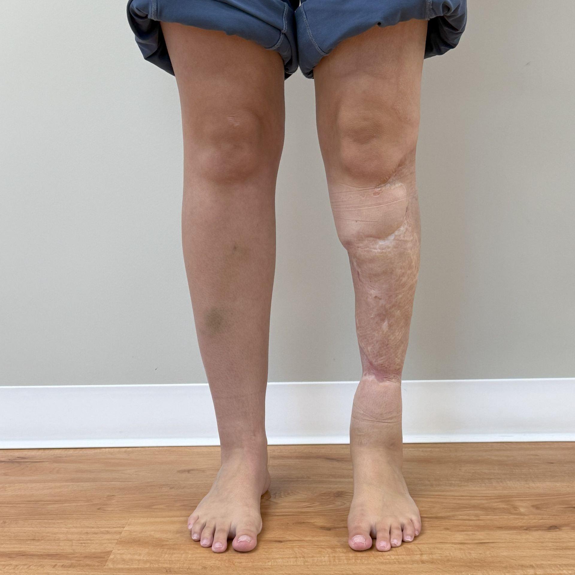 silicone skin cover before image