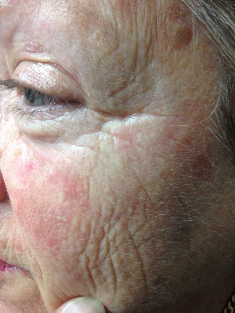donna con cheratosi in viso