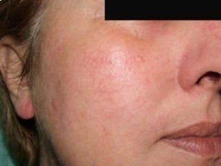 trattamento laser sul viso
