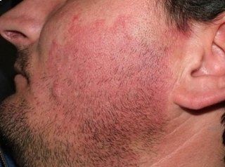 dettaglio viso paziente prima del trattamento