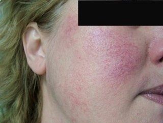 viso donna prima del trattamento couperose
