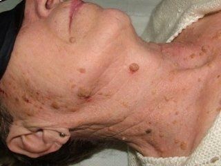 dettaglio collo paziente Neoformazioni cutanee benigne