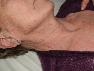 trattamento neoformazioni cutanee benigne