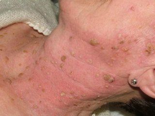 trattamento Neoformazioni cutanee benigne Dr Michelini