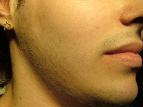 depilazione laser ragazzo