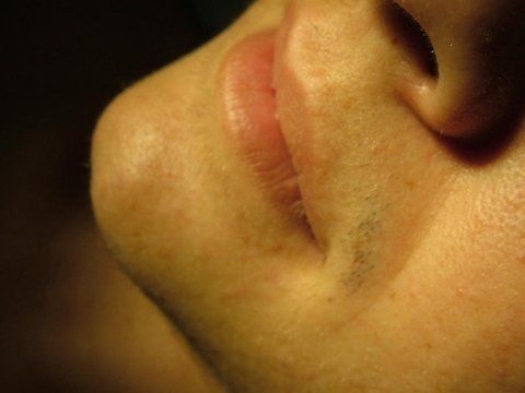 viso  depilazione laser uomo