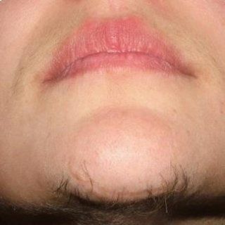 depilazione laser viso