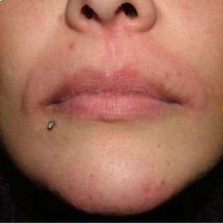 ragazza dopo epilazione laser definitiva