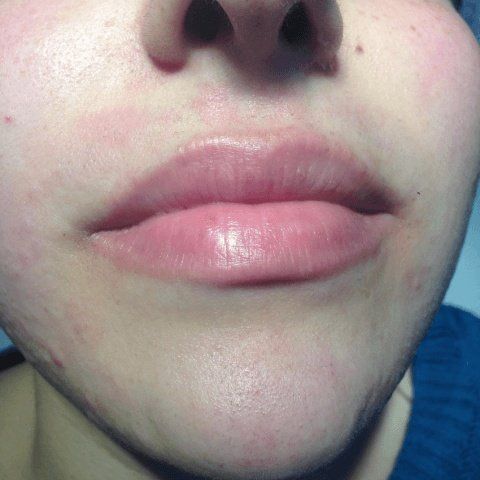 paziente dopo epilazione laser