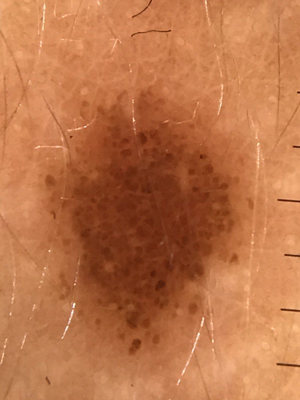 trattamento di mappatura nevi Dermatologo