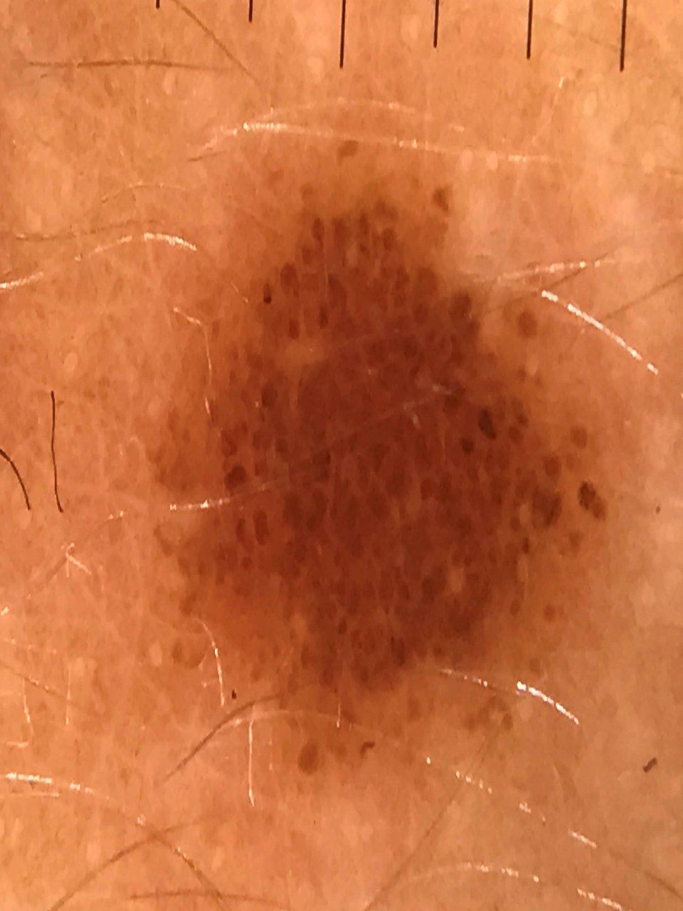 diagnostica melanoma mappatura nevi Dr Michelini
