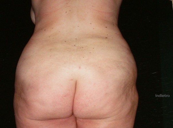 trattamento di lipoaspirazione