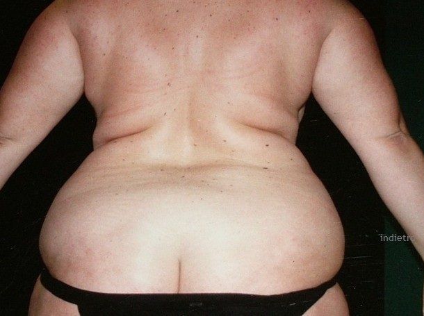 trattamento del microcircolo tessuto adiposo