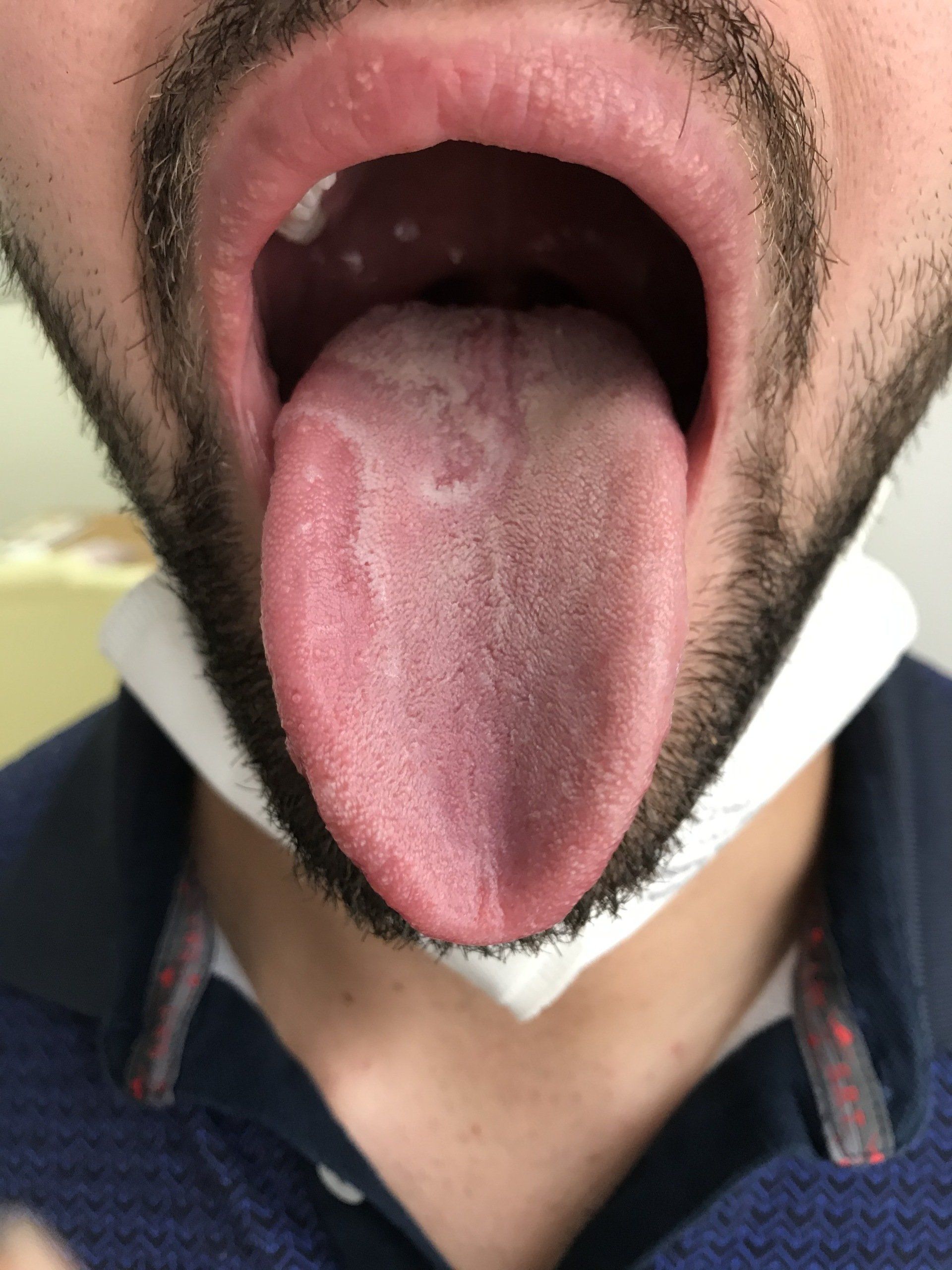 Patologia delle mucose cavo orale