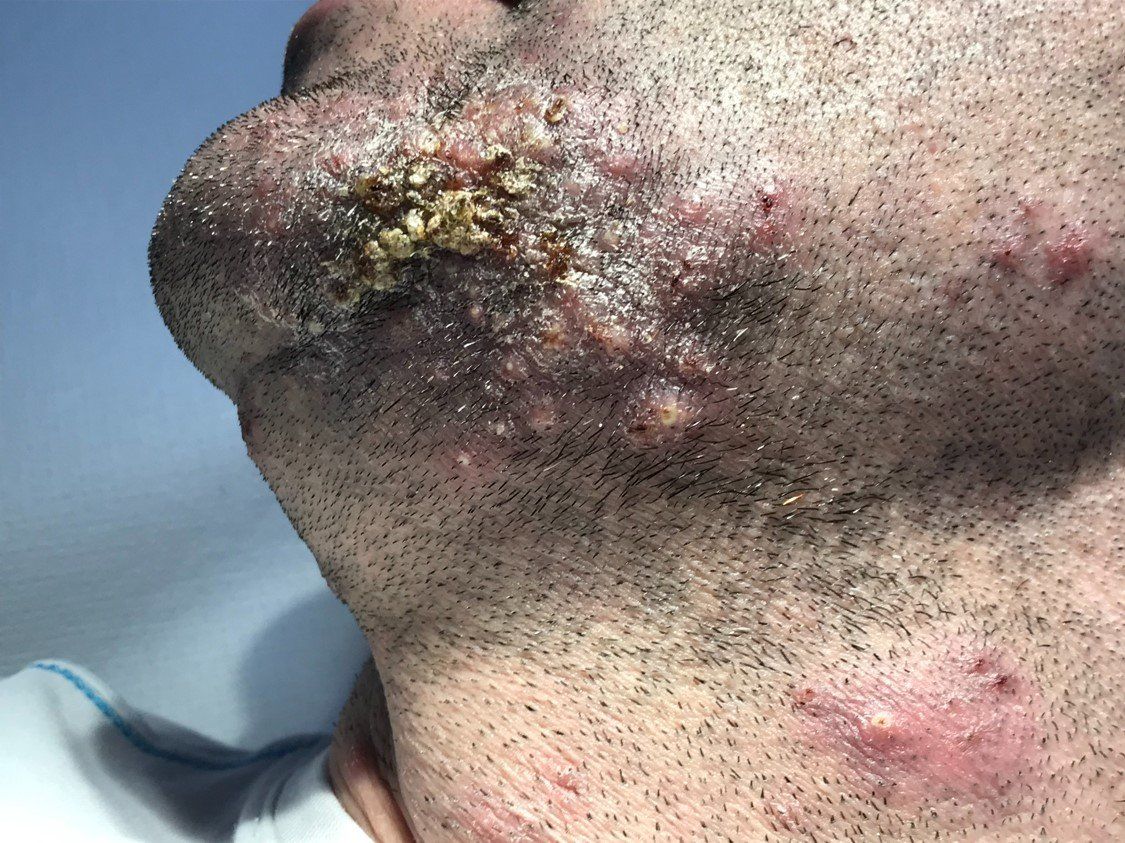Patologie infiammatorie viso