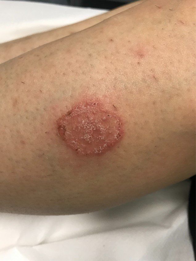 Patologia infiammatoria gamba