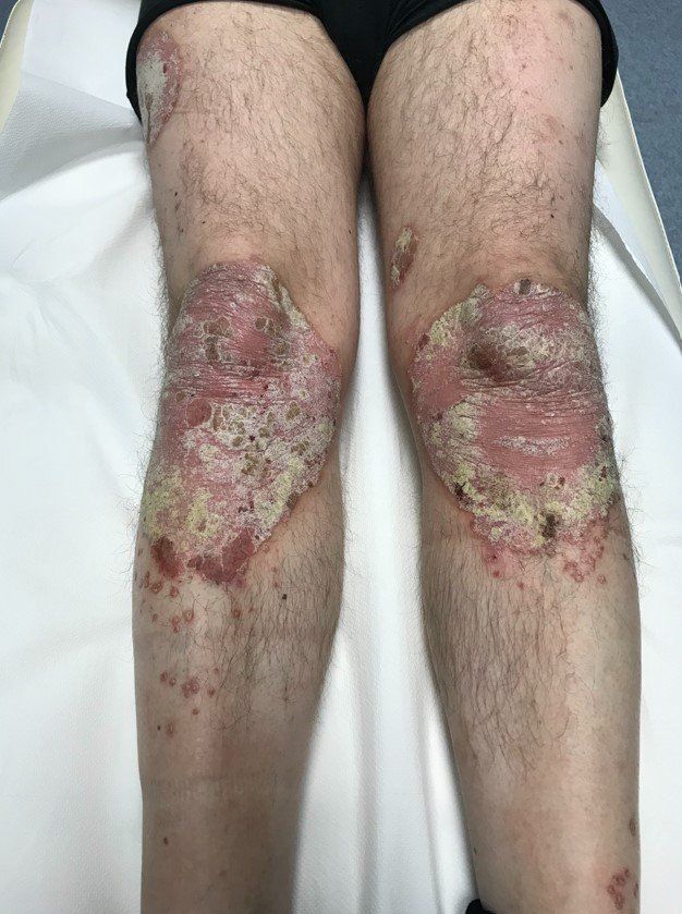 Patologie infiammatorie psoriasi