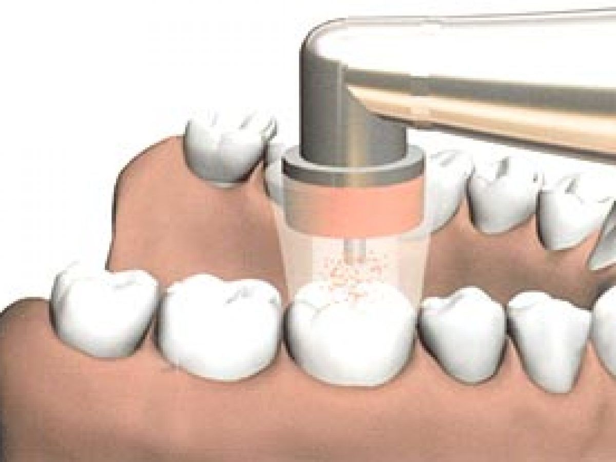 ozone therapy on tooth | Treat and prevent gum disease and bacteria | Dentist near Somerset NJ 08873