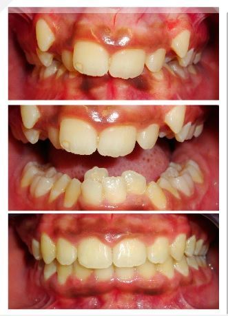 A collage of three pictures of a person 's teeth before and after braces. A collage of three pictures of a person 's teeth before and after braces.