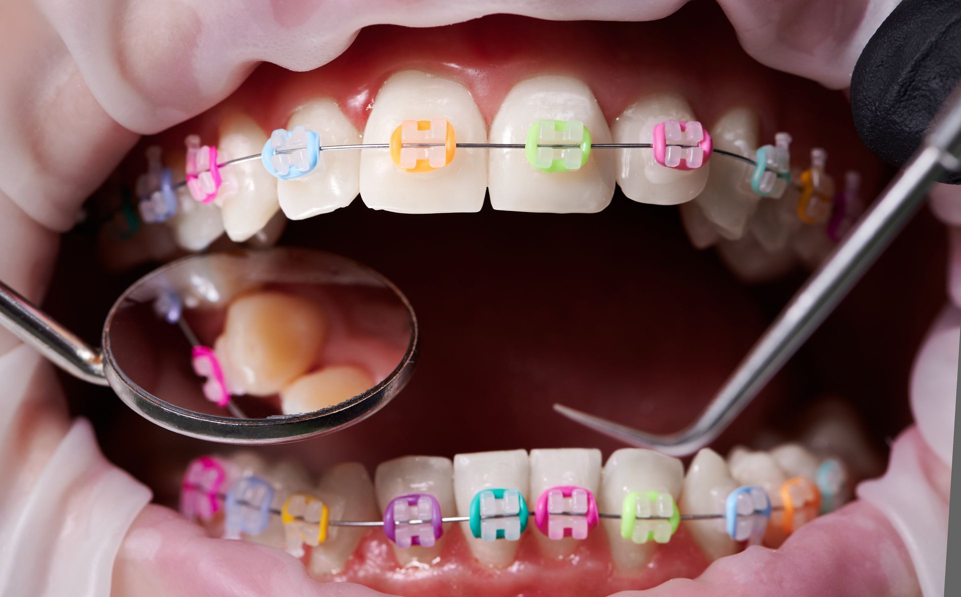 An open mouth with colourful braces being serviced by an orthodontist with a little mirror.