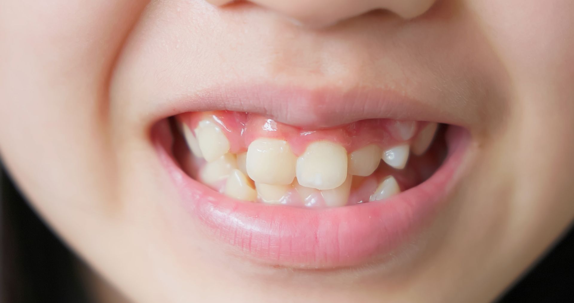 A close up of a child 's mouth with missing teeth.