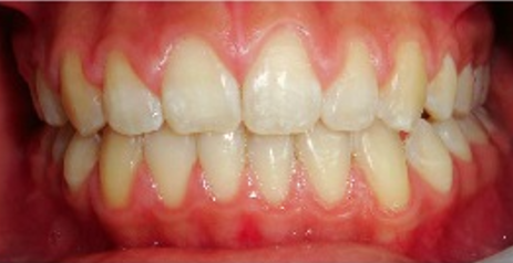 A close up of a person 's teeth and gums.