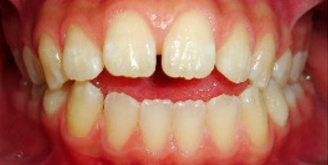 A close up of a person 's teeth with a missing tooth.
