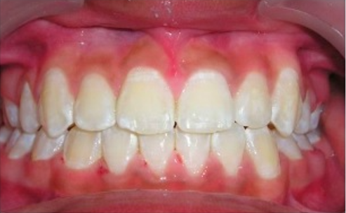 A close up of a person 's teeth with red gums.