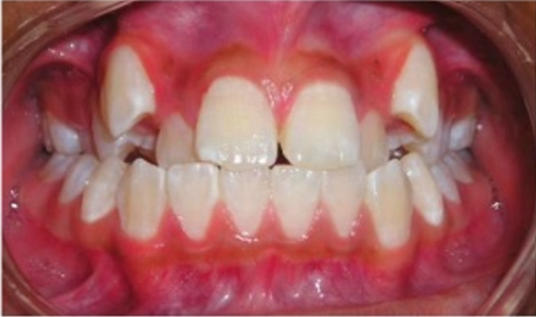 A close up of a person 's teeth with red gums