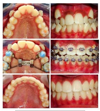 A collage of pictures of a person 's teeth before and after braces A collage of pictures of a person 's teeth before and after braces