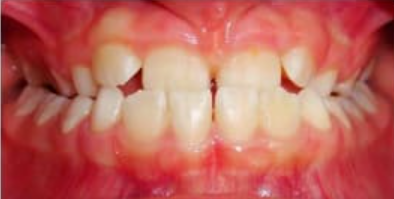 A close up of a person 's teeth with red gums
