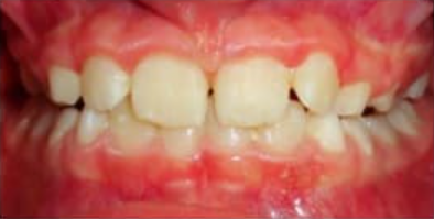 A close up of a person 's teeth with red gums