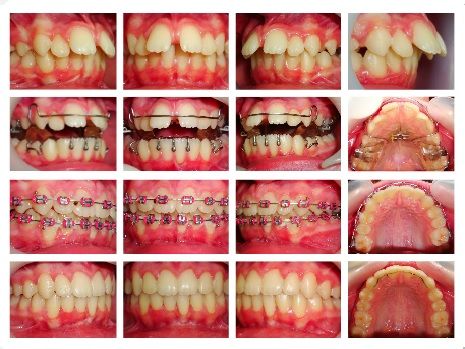 A collage of images of a person 's teeth with braces A collage of images of a person 's teeth with braces