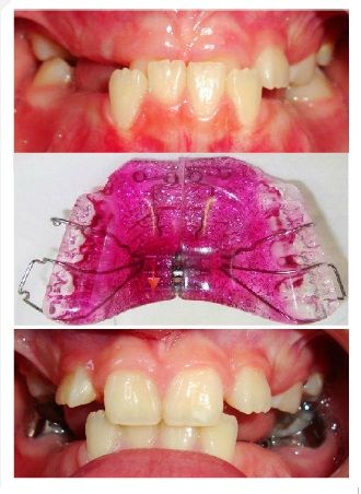 A collage of three pictures of a child 's teeth with braces. A collage of three pictures of a child 's teeth with braces.